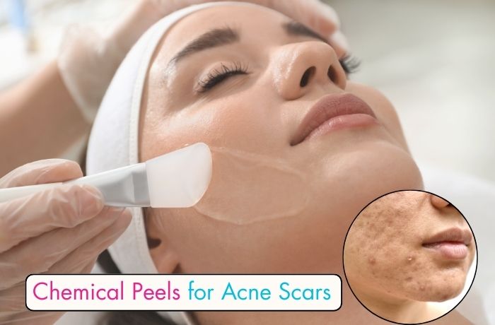 Chemical Peels