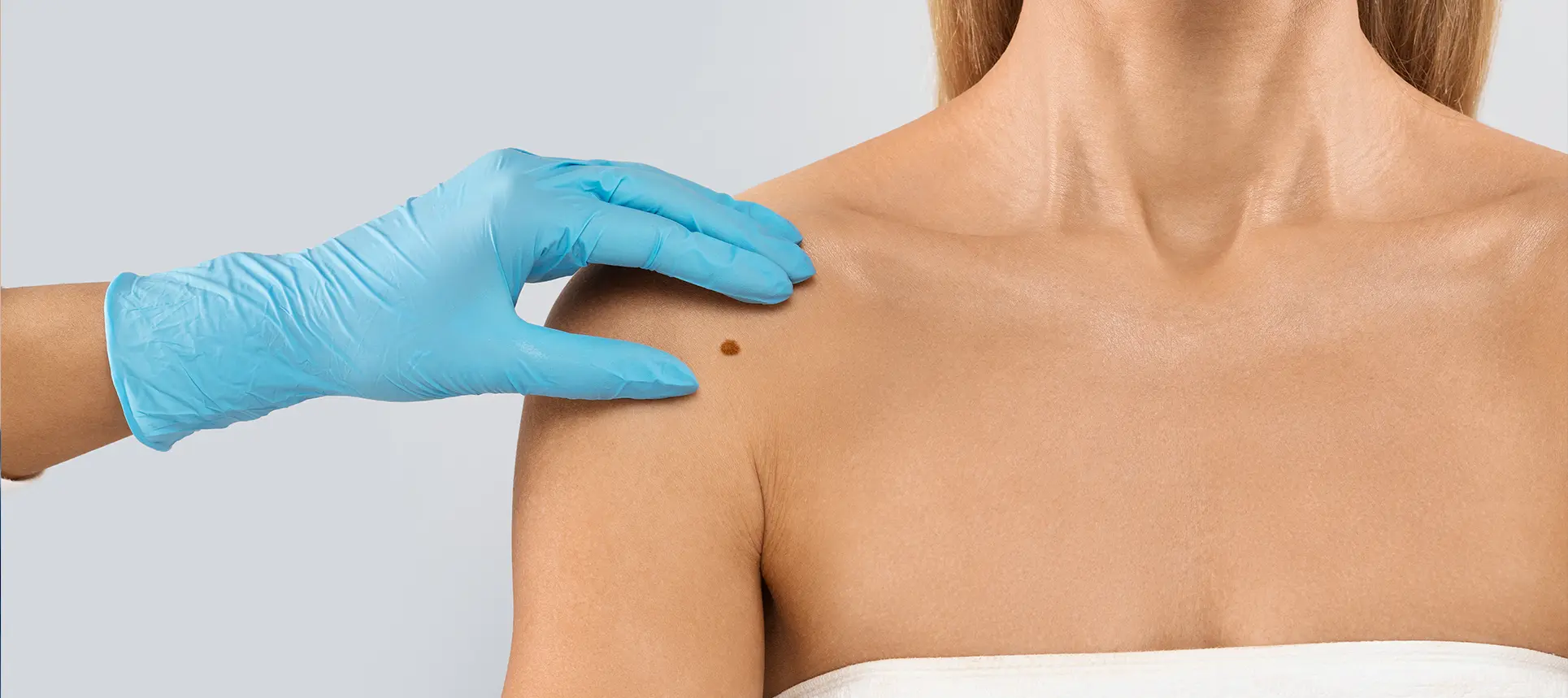 Skin Tag Removal