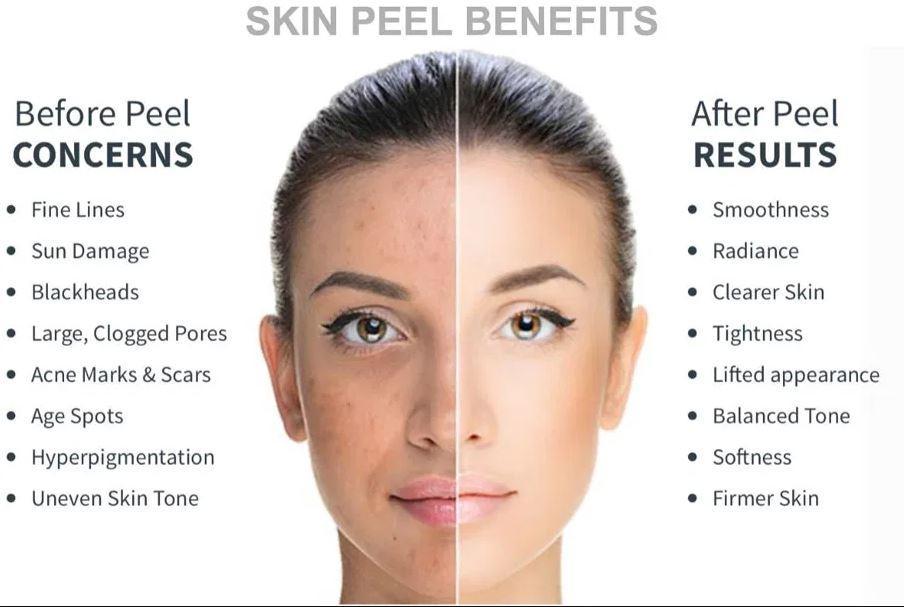Chemical Peel
