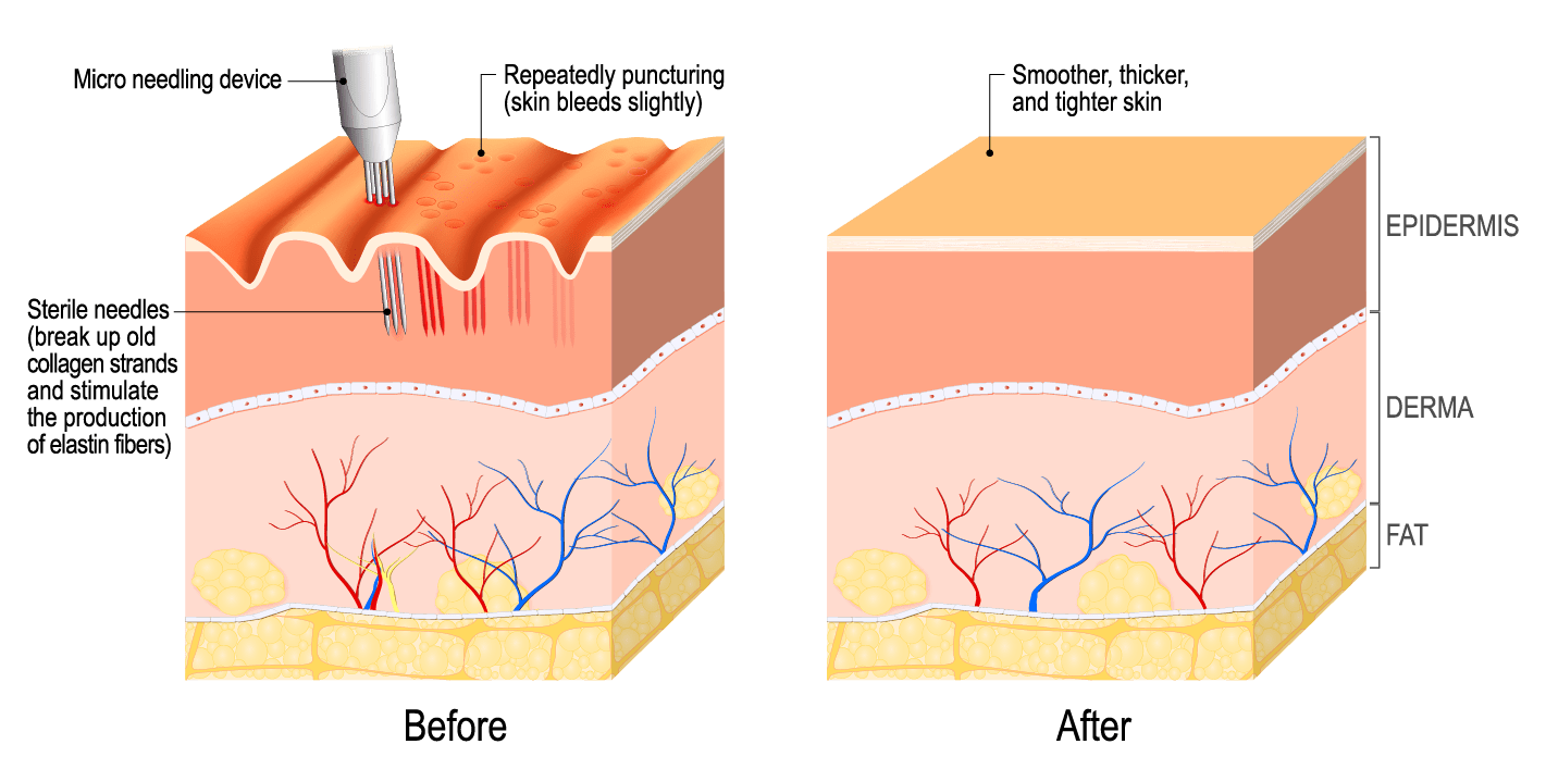 Microneedling Before and After