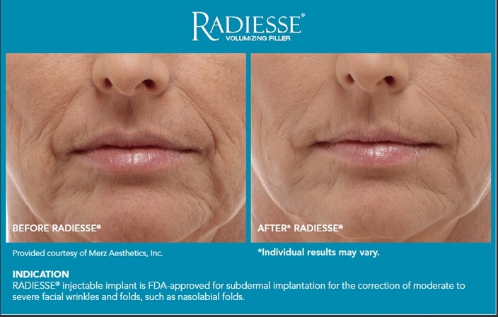 RADIESSE® Filler