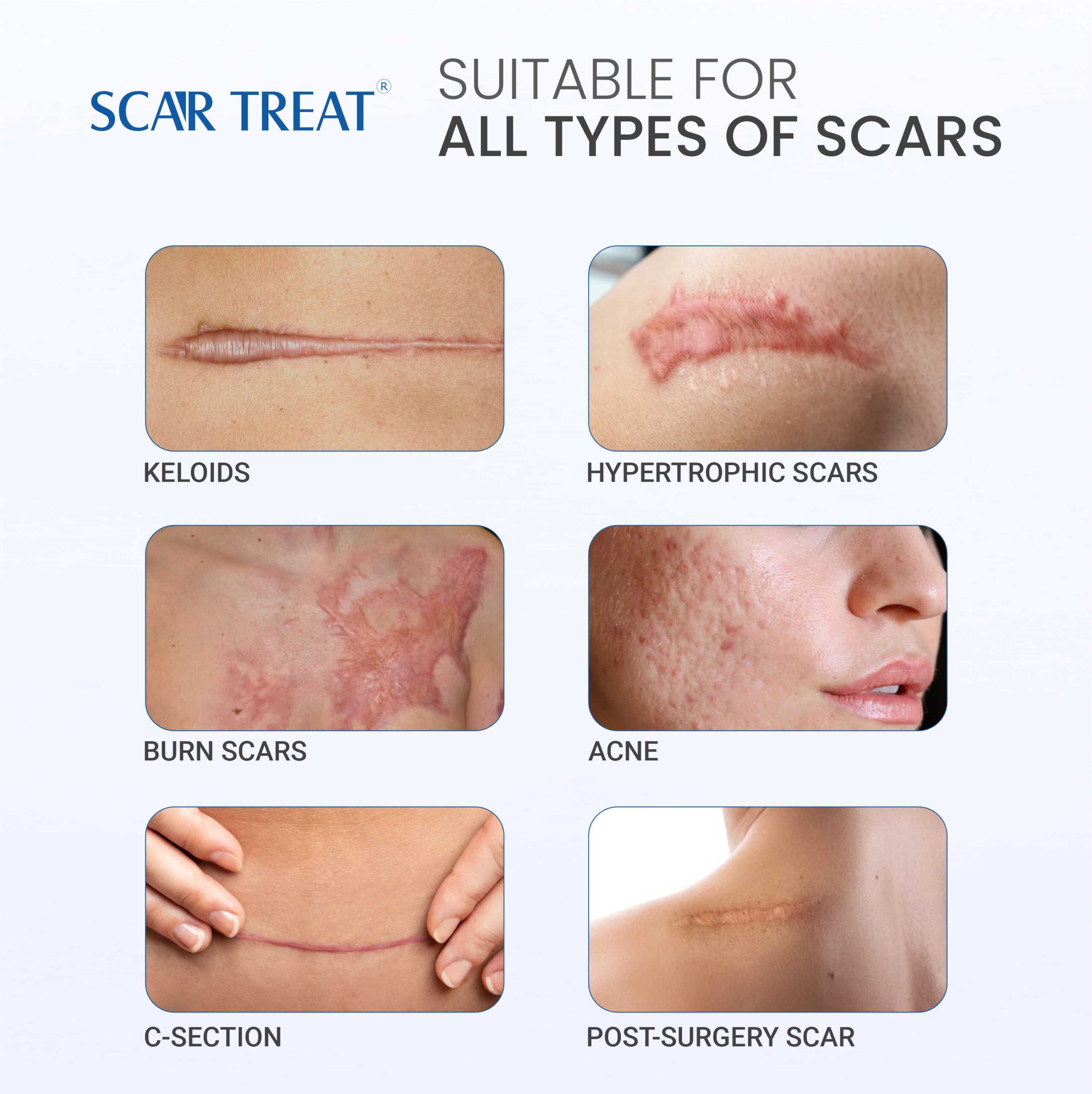 Scar Treatment