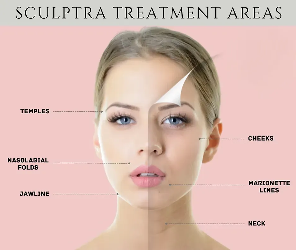 Sculptra treatment
