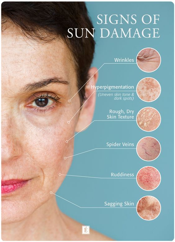 Sun Damage / Hyperpigmentation Treatment