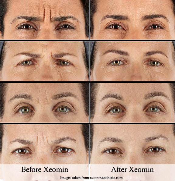 XEOMIN® Treatment